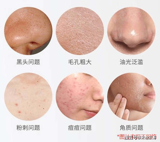 脸部毛孔吸尘器——水肌美碳酸泡泡清洁面膜测评