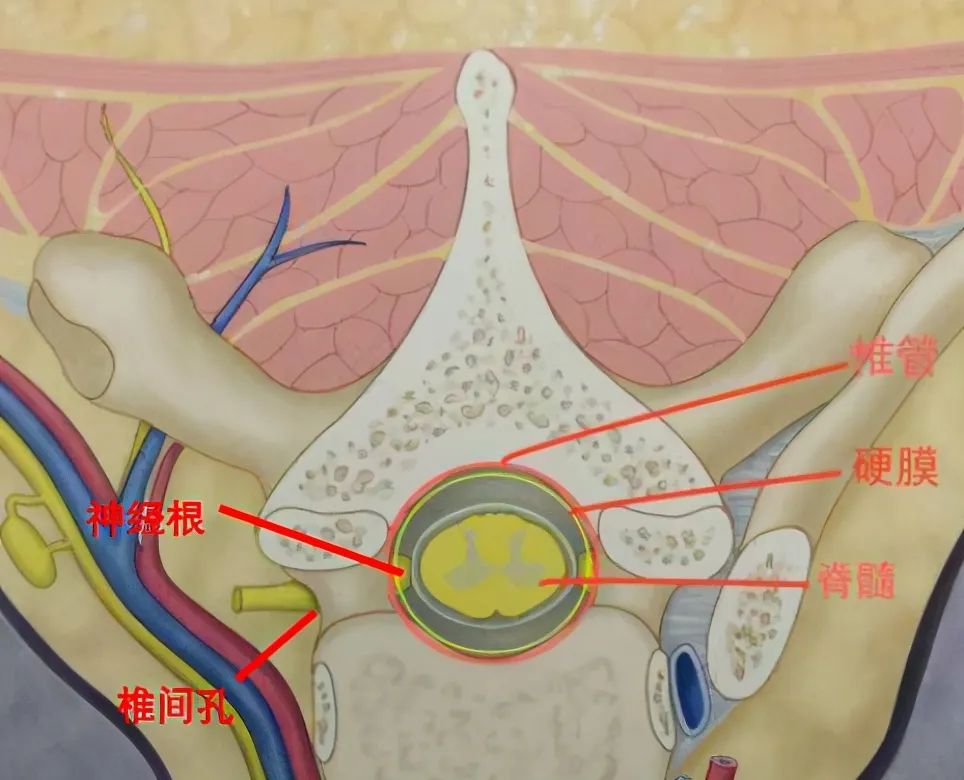 肿瘤|双脚痛且温觉减退 竟是椎管里长了瘤