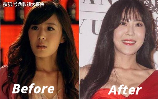 脸部被美容院毁掉的明星，娄艺潇秒变僵尸脸，张檬因整容葬送大好前途