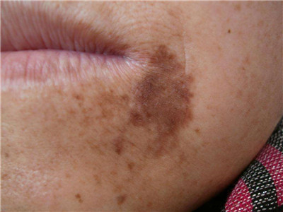 各种意外情况导致皮肤留下黑斑黑印子色素沉着怎么办