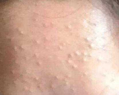 黑头黑头粉刺怎么去，这几招还你干净平滑的脸！