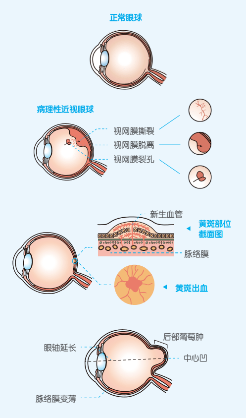 眼底|孩子近视，别只关心度数--眼轴眼底全面监测更科学！