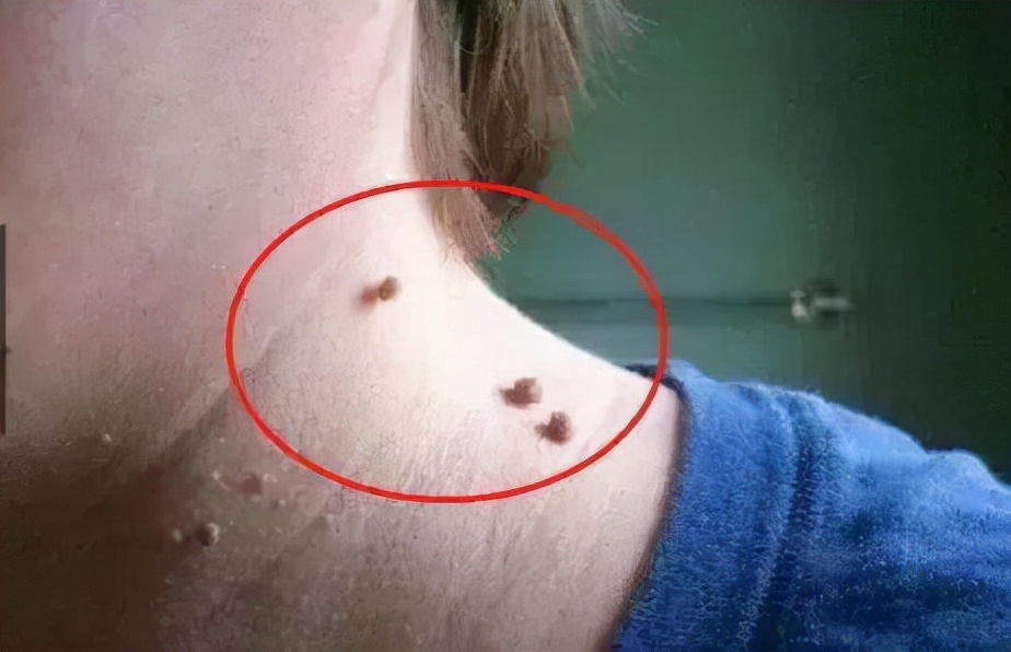 上有这些疙瘩,请礼貌地保持好距离,提防hpv感染_病毒_免疫力_长痘痘