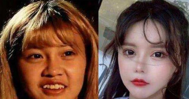 因为16岁网红整容近百次，已开始出现后遗症：视力下降、记忆力衰退