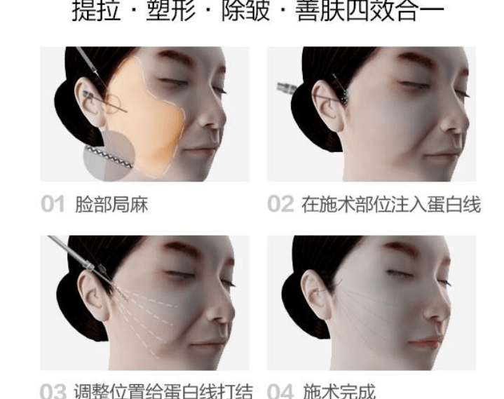 蛋白线雕多久做一次合适：线雕多久做一次比较好、线雕多久才能看到效果？