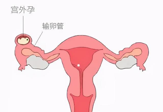 女性输卵管结扎过程图片