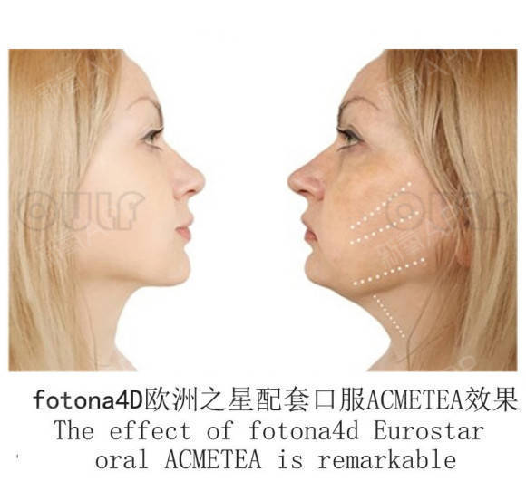治疗欧洲之星fotona4d做一次有效果吗？为了挽回我的青春加油