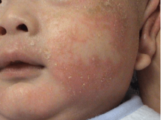 急性期皮损以丘疱疹为主,有渗出倾向;慢性期以苔藓样变为主,皮疹呈多