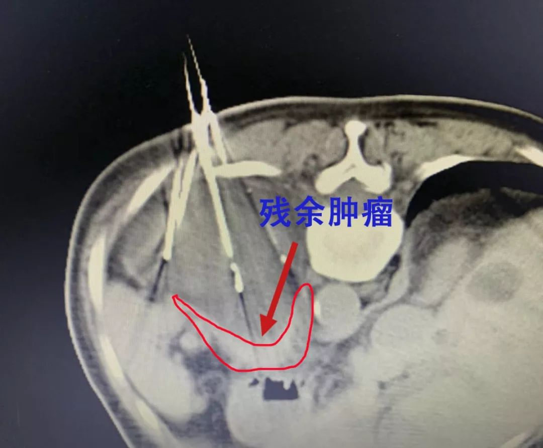 肿瘤|广州复大肿瘤医院案例1012：七旬阿婆患肿瘤三次求医广州复大