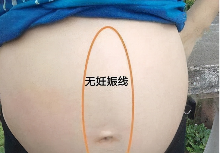 孕期肚皮上的＂黑线＂,生娃后多久会消失?看过后孕妇别担心啦