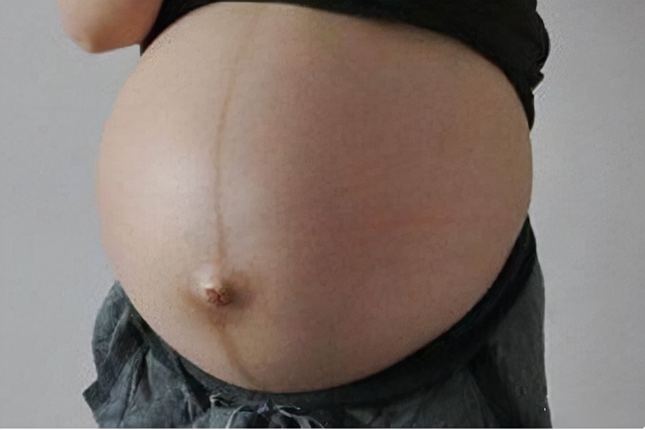 孕期肚皮上的＂黑线＂,生娃后多久会消失?看过后孕妇别担心啦