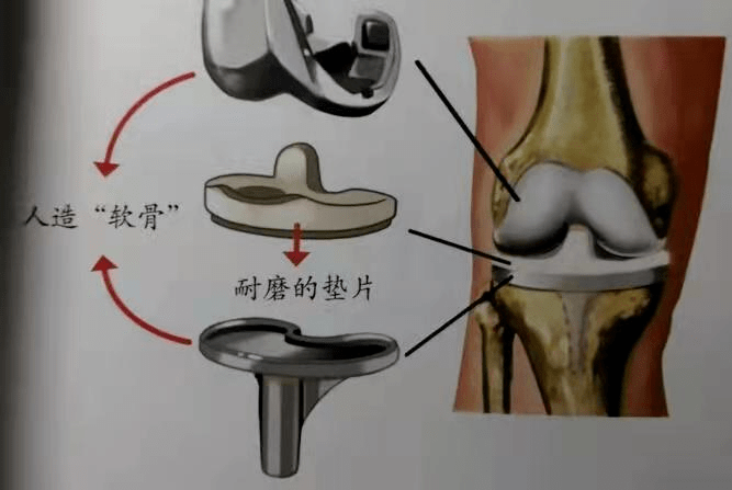 骨在線膝關節置換術為您的膝關節保駕護航