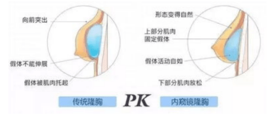 进行完美体态不可缺少的美胸，这样塑造