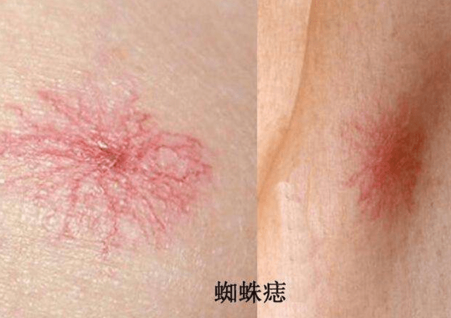 右侧,肝病患者若是发现右腹部肋骨下方具有明显刺痛以及钝痛不适感