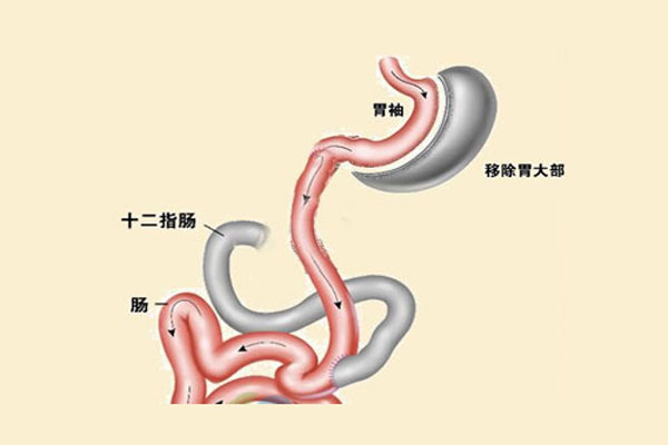 腹腔镜|减重手术丨王存川谈精准腹腔镜袖状胃旁路手术的原理效果