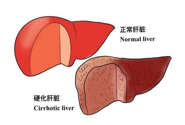 双抗|想要治好肝硬化，仅依靠抗病毒治疗远远不够