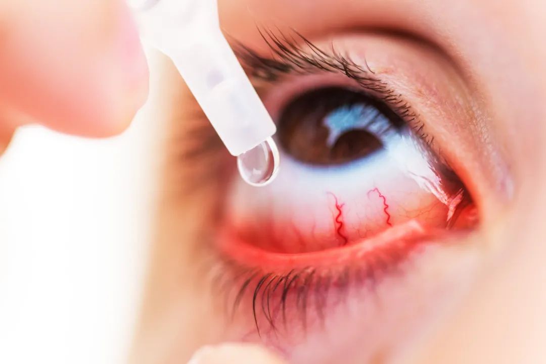 视网膜|网红眼药水导致视网膜脱落？用眼药水前，一定要知道的事