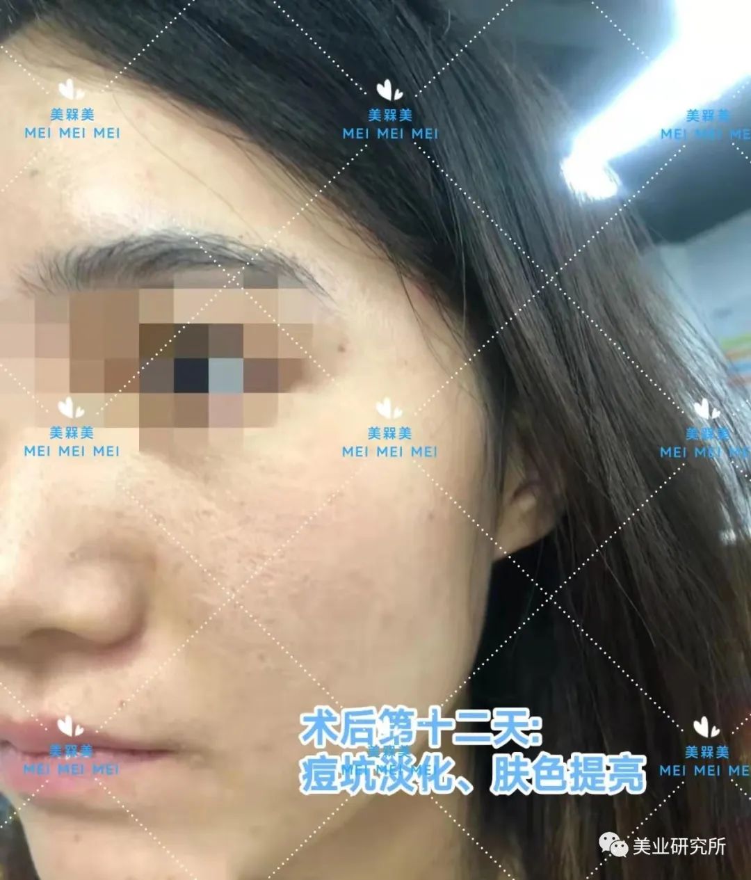 因为【美人汇】痘坑究竟该如何攻克？