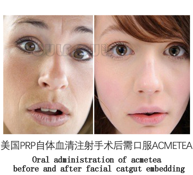 进行埋线多久才能完全恢复自然、做完变身女主的我有话说