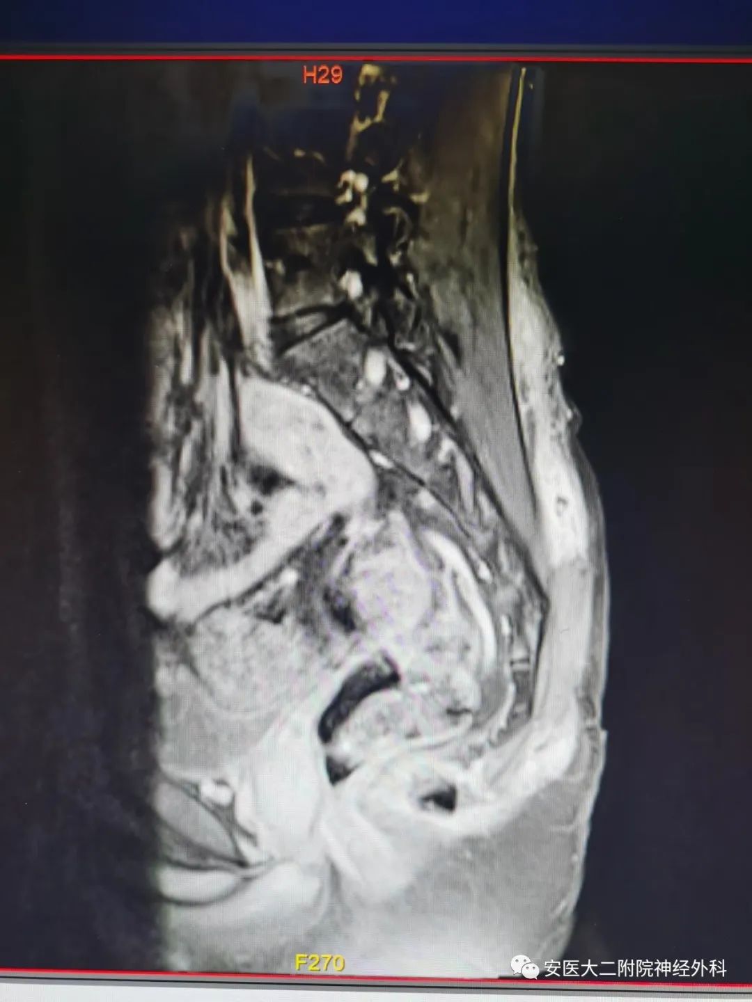 赵兵|MDT模式下完成骶尾部巨大表皮样囊肿手术切除一例