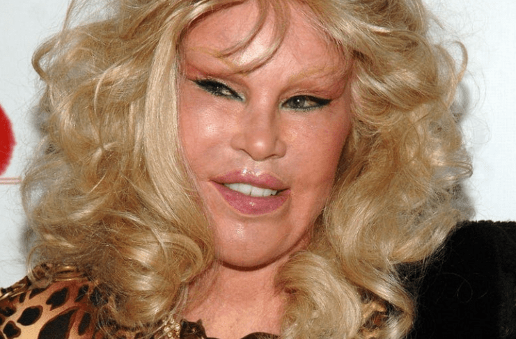 整容狂人乔斯林:嫁豪门失败,离婚分得25亿美元,如今怎么样了?