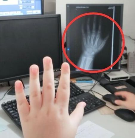 通常,拍摄左手腕的x光片,然后全面分析骨骼的年龄.