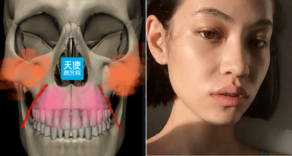 可以将颧骨和上颌骨想象成两座大山,红色交界部分是峡谷,当粉色这部分