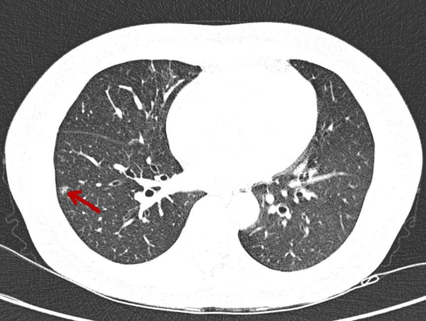 肺结节ct报告单图片