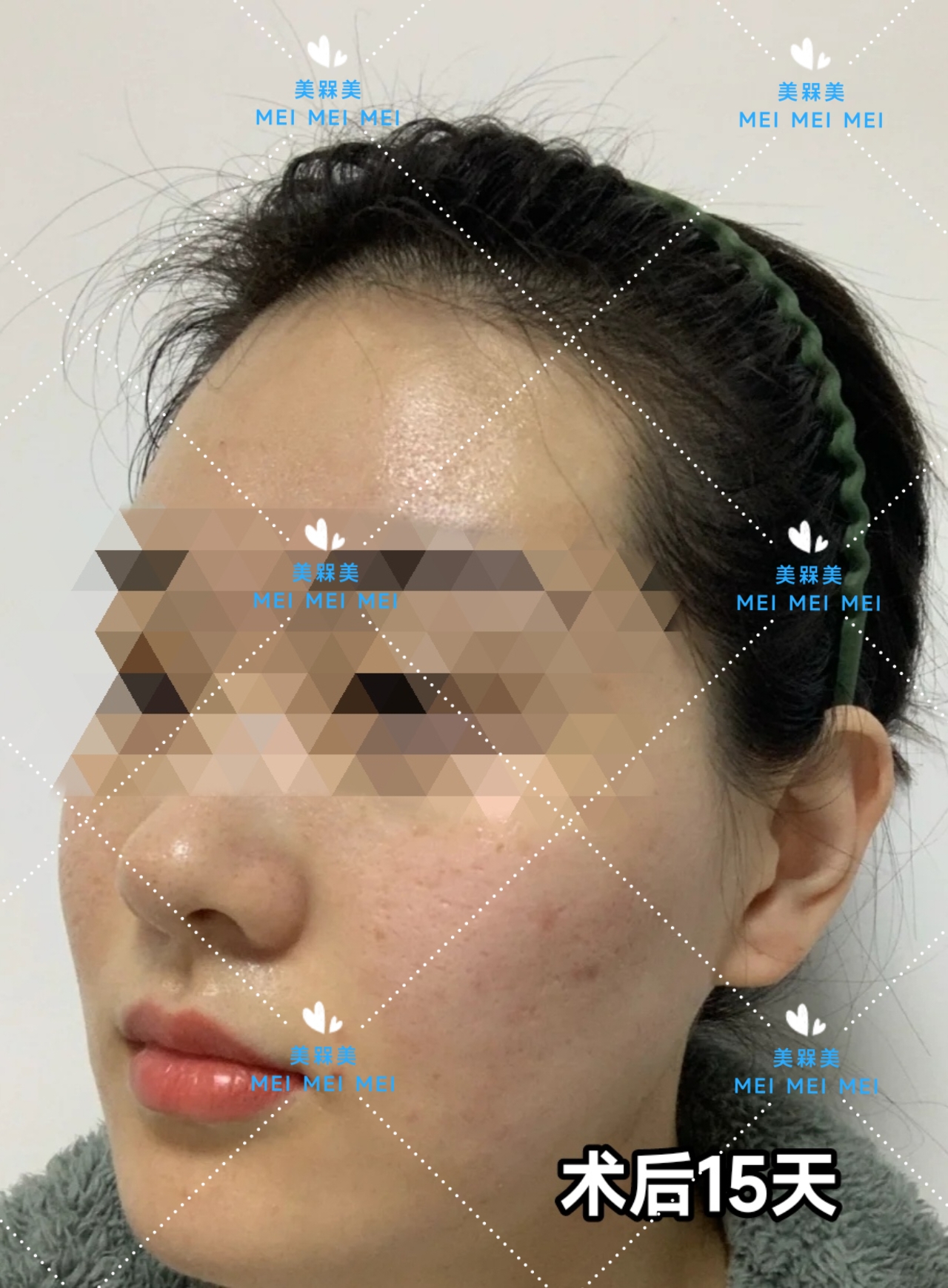 差不多【美人汇】痘痘肌少女的逆袭之路