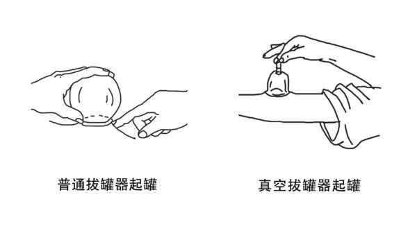 原创拔罐虽好但有5类人不适合还有4件事别忘了做望周知
