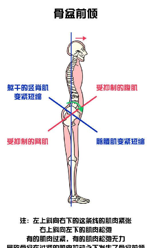 骨盆前倾危害大,如何自我测试和纠正?看这一篇就够了,男女通用_身体_