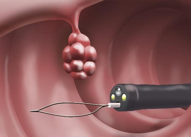 肠息肉发病早期粪便会出现前头干影后,头发软的表现,肠粘膜表面有明显