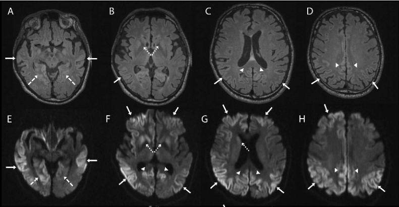 朊病毒有多可怕?"笑死病"的元凶,约90%的感染者会在1年内死亡