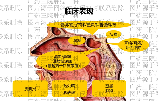 咽痛涕血彭齊榮教授小心鼻咽癌