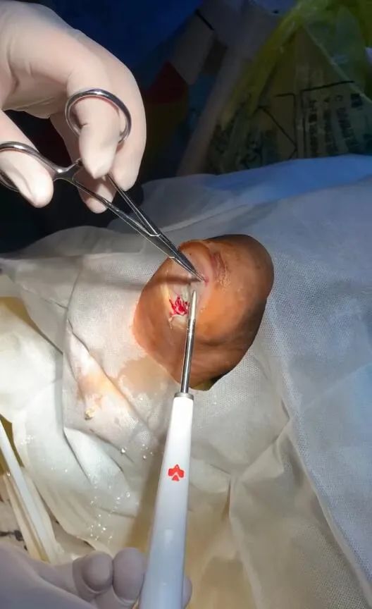 海卓水刀走进郴州市第一人民医院