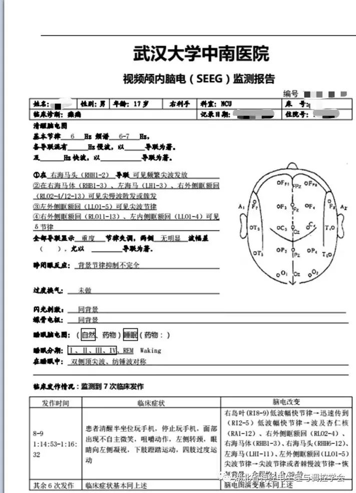右前中颞底)sz2(4)(右额极,右前中颞底)sz1 右颞底(avg)pet ct 无异常