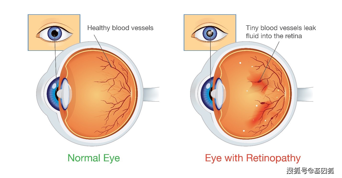 健康科普糖尿病视网膜病变简介