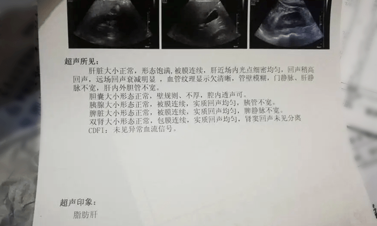 肝癌B超图片
