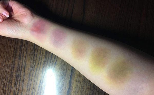 可能不是磕碰那么简单,别大意_血液_受伤_血小板