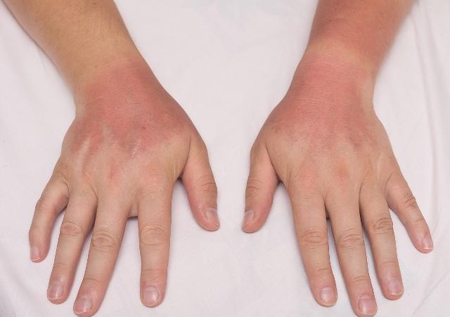 人们在夏天如果皮肤晒伤,出现了皮肤发红,疼痛的症状,首要第一步就是