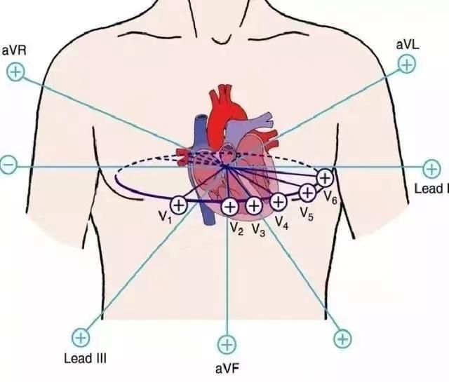 心电图人体位置图片