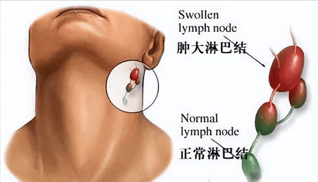 颈部痰核症状图片图片