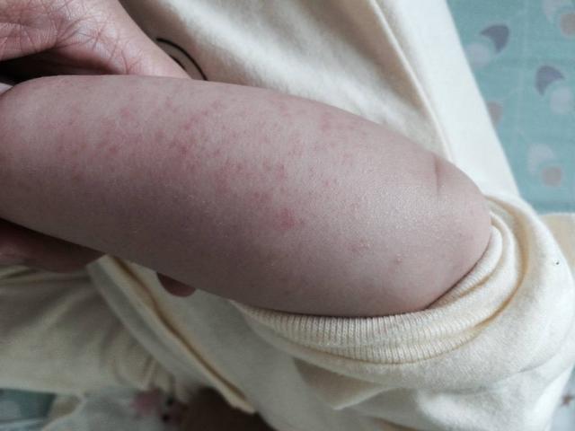 宝宝有过敏反应,对一些东西过敏,比如蔬菜,鸡蛋,水果等,家长应当如实