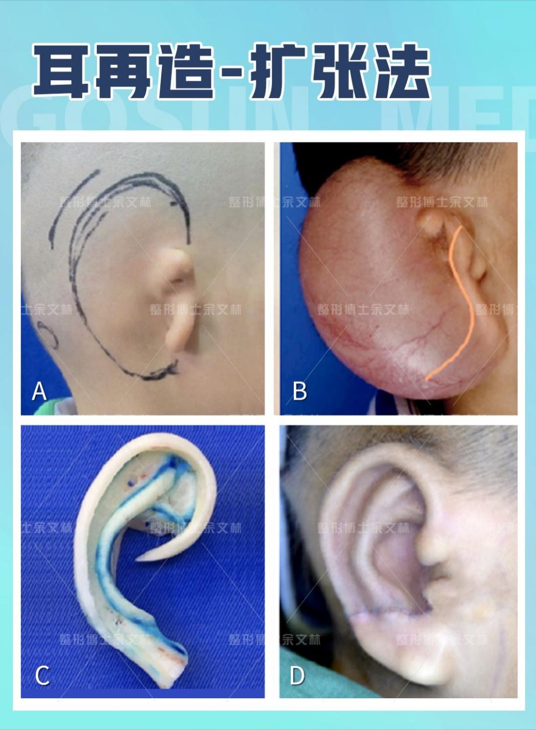 耳朵畸形手术图片