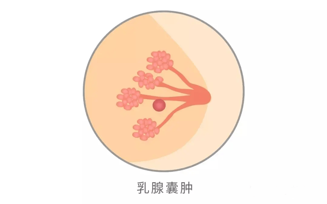 乳腺增生乳腺結節會變成癌症嗎聊聊全球第一大癌乳腺癌