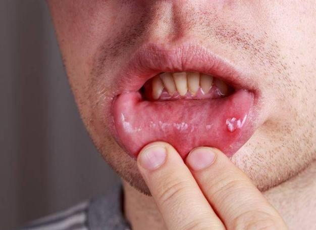 原创嘴里若经常出现这5个异常警惕是口腔癌来袭很少有人重视
