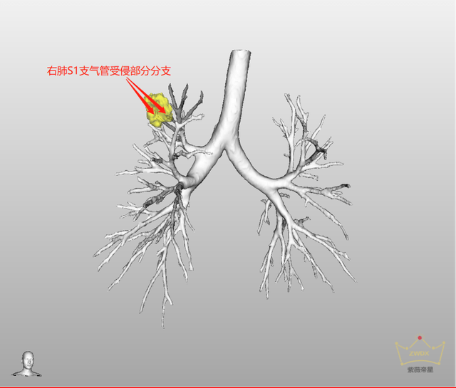 右肺支气管三维图图片