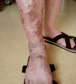 筋疙瘩蚯蚓腿静脉曲张这个动作有奇效