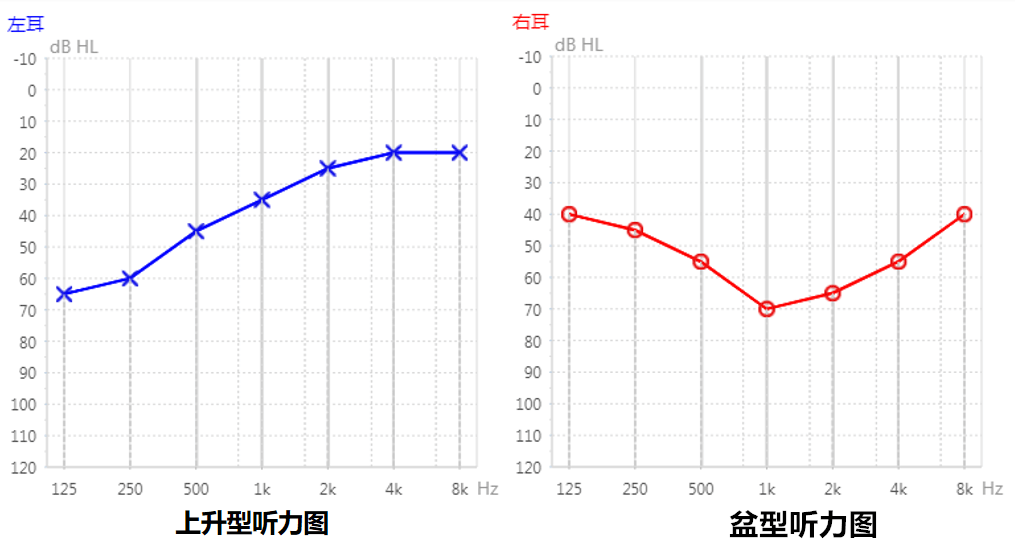 根據氣導聽力曲線的形狀,聽力圖大致可以分為:平坦型,漸降型,陡降型