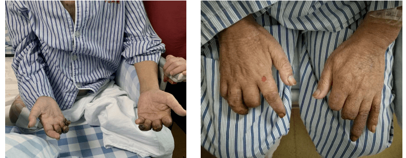 反复截肢的尿毒症患者血液科苏宁副主任医师团队分享了题为《持续